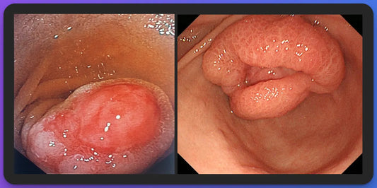 Inflammatory Fibroid Polyps (IFP) or Vanek Tumors of the GI Tract