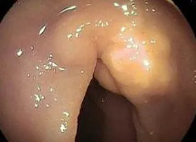 Cavernous Lymphangioma in Small Bowel: Causes, Symptoms, and Treatment Options