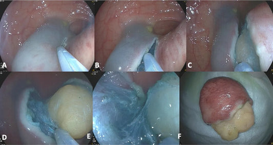 The ESD-EMR Hybrid Technique for Improved Endoscopic Resection