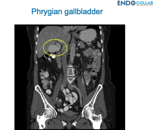 Understanding the Phrygian Cap Gallbladder: Common Congenital Variation and Its Implications