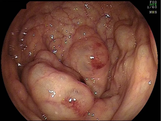 Pneumatosis Coli: Characteristics, Diagnosis, and Etiologies