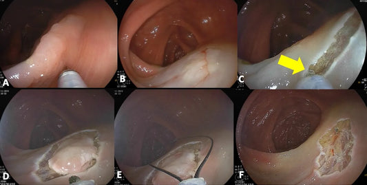 The Hybrid ESD-EMR Technique Explained