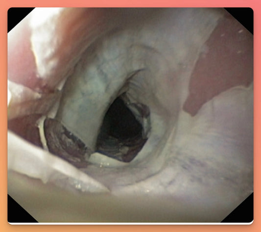 (DIE) - Dabigatran-Induced Exfoliative Esophagitis