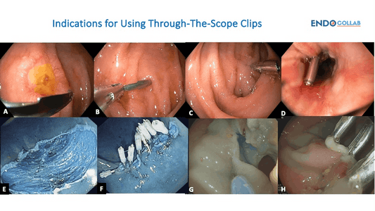 Mastering the Use of Hemoclips (Through-The-Scope-Clips)